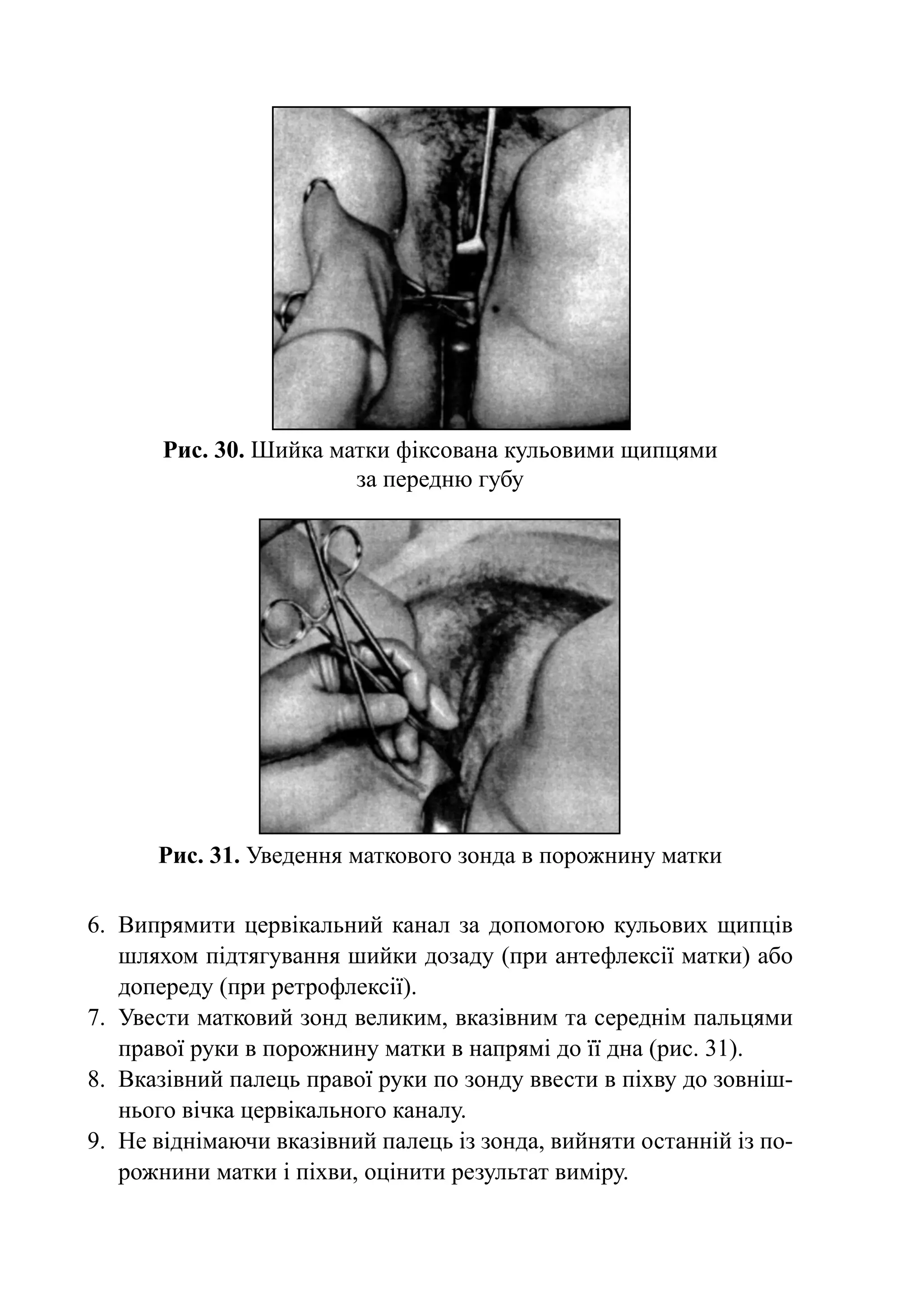Рис. 30. Шийка матки фіксована кульовими щипцями
                        за передню губу




       Рис. 31. Уведення маткового зонда в порожнину матки

6.	 Випрямити цер­ і­ а­ ь­­­­
                    в к л ний канал за до­ о­ огою кульових щип­­
                                            п м                    ців
    шляхом під­ я­ у­ ан­ я шийки до­ а­ у (при антефлексії матки) або
                т г в н             з д
    допереду (при ретрофлексії).
7.	 Увести матковий зонд великим, вказівним та середнім пальцями
    пра­ ої руки в порожнину матки в напрямі до її дна (рис. 31).
       в
8.	 Вказівний палець правої руки по зонду ввести в піхву до зовніш-
    нього вічка цервікального каналу.
9.	 Не віднімаючи вказівний палець із зонда, вийняти останній із по-
    рожнини матки і піхви, оцінити результат виміру.
 