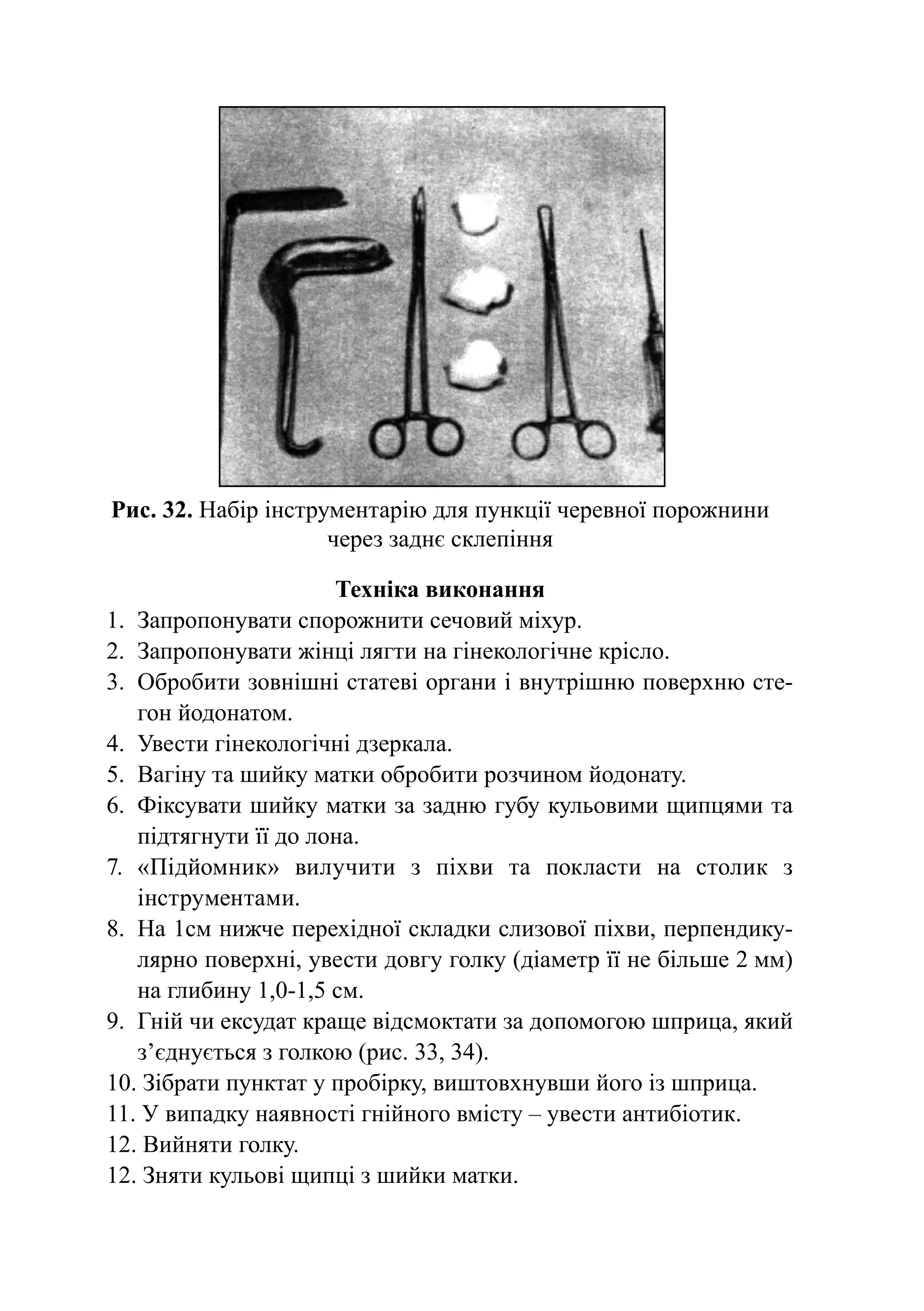 Рис. 32. Набір інструментарію для пункції черевної порожнини
                     через заднє склепіння

                       Техніка виконання
1.	 Запропонувати спорожнити сечовий міхур.
2.	 Запропонувати жінці лягти на гінекологічне крісло.	
3.	 Обробити зовнішні статеві органи і внутрішню по­­ х­ ю сте-
                                                       вер­ н
    гон йодонатом.
4.	 Увести гінекологічні дзер­ а­ а.
                             к л
5.	 Вагіну та шийку матки обробити розчином йодонату.
6.	 Фіксувати шийку матки за задню губу кульовими щипцями та
    підтягнути її до лона.
7.	 «Підйомник» вилучити з піхви та покласти на столик з
    інструментами.
8.	 На 1см нижче перехідної складки слизової піхви, пер­ ен­ ику­
                                                          п д
    лярно поверхні, увести довгу голку (діаметр її не більше 2 мм)
    на глибину 1,0-1,5 см.
9.	 Гній чи ексудат краще відсмоктати за допомогою шприца, який
    з’єднується з голкою (рис. 33, 34).
10. Зібрати пунктат у про­ ір­ у, виштовхнувши його із шприца.
                           б к
11. У випадку наявності гнійного вмісту – увести антибіотик.
12. Вийняти голку.
12. Зняти кульові щипці з шийки матки.
 