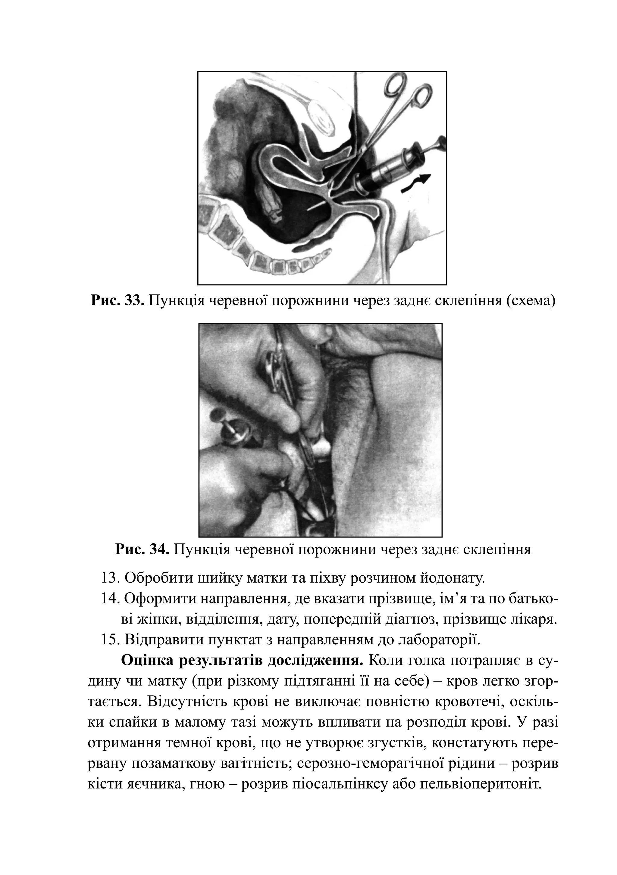 Рис. 33. Пункція черевної порожнини через заднє склепіння (схема)




    Рис. 34. Пункція черевної порожнини через заднє склепіння
  13. Обробити шийку матки та піхву розчином йодонату.
  14. Оформити направлення, де вказати прізвище, ім’я та по бать­ о­­
                                                                   к
     ві жінки, відділення, дату, попе­ едній діагноз, прізвище ліка­ я.
                                     р                             р
  15. Відправити пунктат з направленням до лабораторії.
     Оцінка результатів дослідження. Коли голка потрапляє в су-
дину чи матку (при різкому підтяганні її на себе) – кров легко згор-
тається. Відсутність крові не виключає повністю кровотечі, оскіль-
ки спайки в малому тазі можуть впливати на розподіл крові. У разі
отримання темної крові, що не утворює згустків, констатують пере-
рвану позаматкову вагітність; серозно-геморагічної рідини – розрив
кісти яєчника, гною – розрив піосальпінксу або пельвіоперитоніт.
 