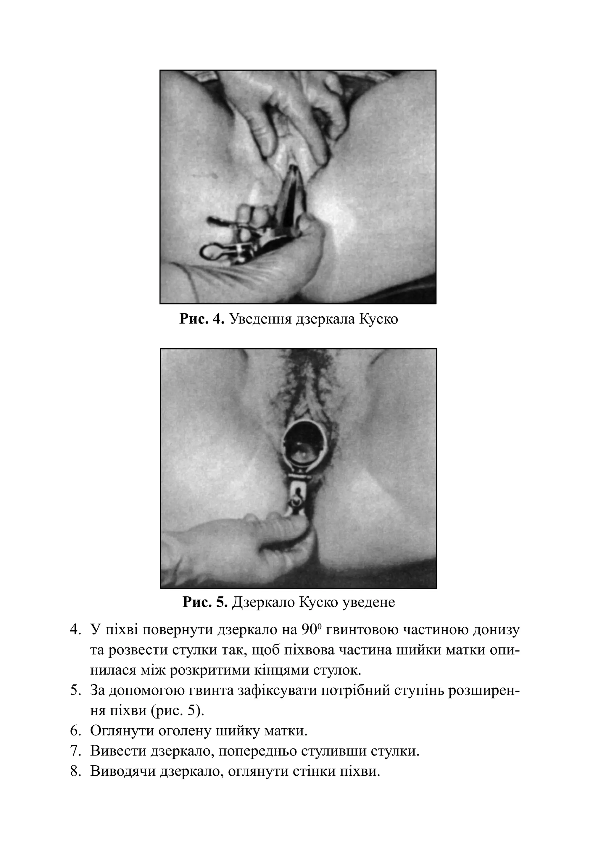 Рис. 4. Уведення дзеркала Куско




                Рис. 5. Дзеркало Куско уведене
4.	 У піхві повернути дзеркало на 900 гвинтовою частиною донизу
    та розвести стулки так, щоб піхвова частина шийки матки опи-
    нилася між розкритими кінцями стулок.
5.	 За допомогою гвинта зафіксувати потрібний ступінь роз­ и­ ен­
                                                         ш р
    ня піхви (рис. 5).
6.	 Оглянути оголену шийку матки.
7.	 Вивести дзеркало, попередньо стуливши стулки.	
8.	 Виводячи дзеркало, оглянути стінки піхви.
 