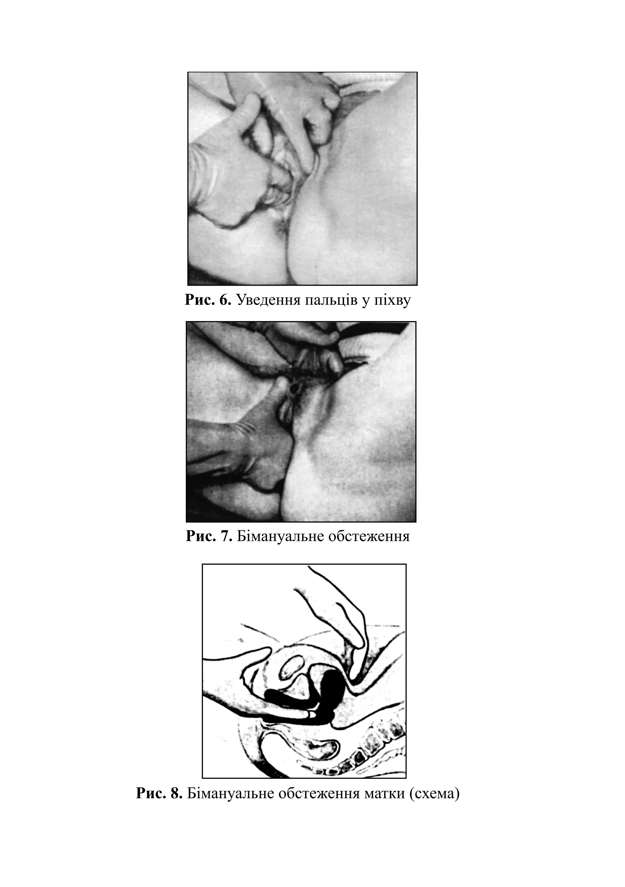 Рис. 6. Уведення пальців у піхву




      Рис. 7. Бімануальне обстеження




Рис. 8. Бімануальне обстеження матки (схема)
 