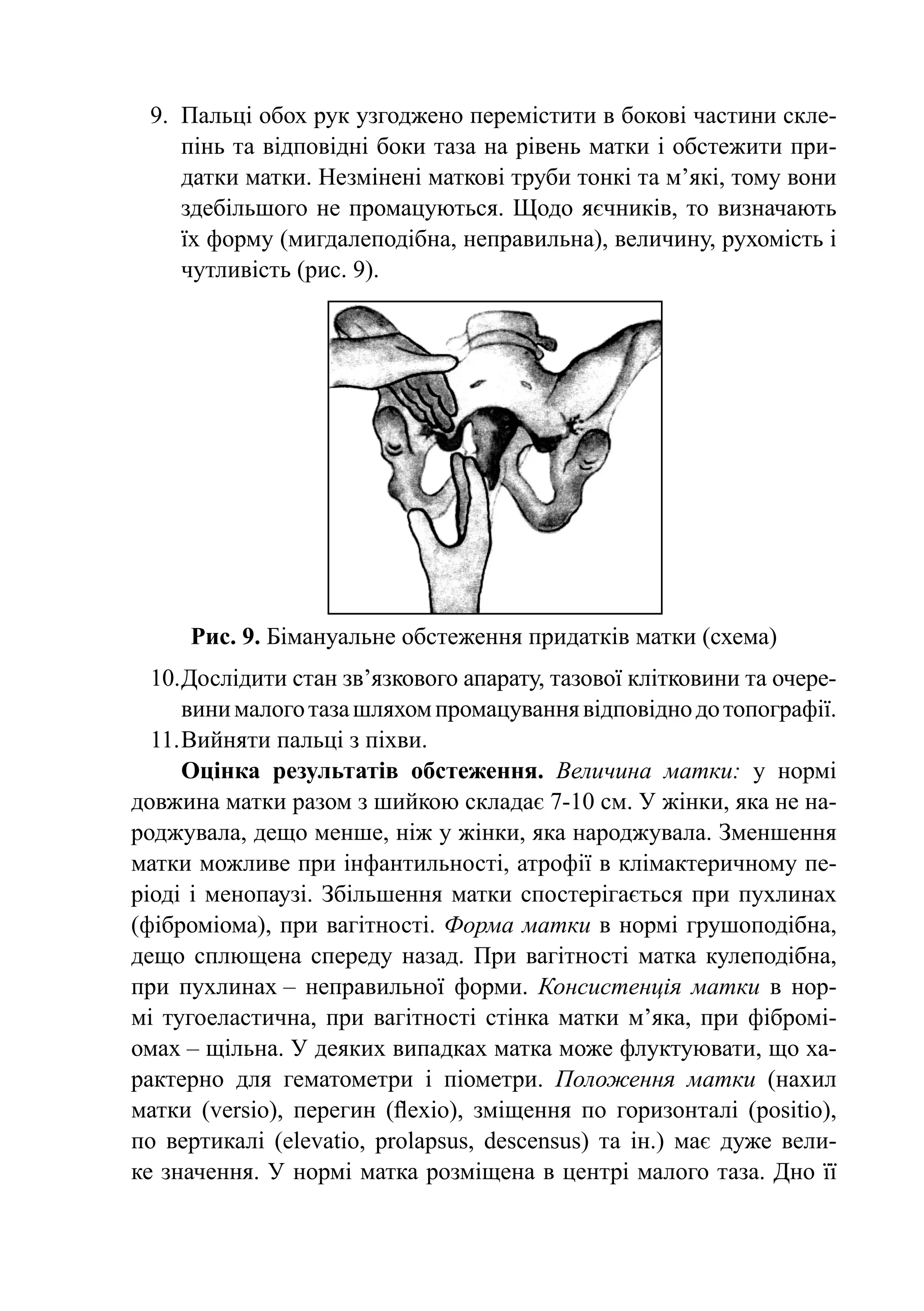 9.	 Пальці обох рук уз­ од­ е­­ пе­ емістити в бокові частини скле­
                           г ж но р
     пінь та від­ о­ ід­ і боки таза на рівень матки і обстежити при-
                п в н
     датки матки. Незмі­ е­ і маткові труби тонкі та м’які, тому вони
                           н н
     здебільшого не про­ а­ у­ ться. Щодо яєч­ иків, то визначають
                            м ц ю                н
     їх форму (мигдалеподібна, не­ ра­ иль­ а), ве­ и­ ину, рухомість і
                                     п в н         л ч
     чутливість (рис. 9).




     Рис. 9. Бімануальне обстеження придатків матки (схема)
  10.	 ослідити стан зв’язкового апарату, тазової клітковини та очере-
      Д
      вини малого таза шляхом промацування відповідно до топографії.
  11.	Вийняти пальці з піхви.
      Оцінка результатів обстеження. Величина матки: у нормі
дов­ ина матки разом з шийкою складає 7-10 см. У жінки, яка не на­
    ж
род­ увала, дещо менше, ніж у жінки, яка народжувала. Зменшення
    ж
мат­ и можливе при інфантильності, атрофії в клімактеричному пе-
    к
ріоді і менопаузі. Збільшення матки спостерігається при пухлинах
(фіб­ о­ іо­ а), при вагітності. Форма матки в нормі грушоподібна,
     р м м
дещо сплю­­  щена спереду назад. При вагітності матка кулеподібна,
         л нах – неправильної форми. Консистенція матки в нор-
при пух­ и­­
мі туго­ ­ ас­ ич­ а, при вагітності стінка матки м’яка, при фібромі-
        ел т н
омах – щіль­ а. У деяких випадках матка може флуктуювати, що ха-
              н
рактерно для ге­ а­ ометри і піометри. Положення матки (нахил
                   м т
матки (versio), пе­ е­ ин (flexio), зміщення по горизонталі (positio),
                     р г
по вертикалі (elevatio, prolapsus, descensus) та ін.) має дуже вели-
ке значення. У нормі матка роз­ іщена в центрі малого таза. Дно її
                                  м
 