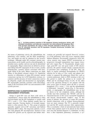 Algoritmo cateterization atresia pulmonar | PDF