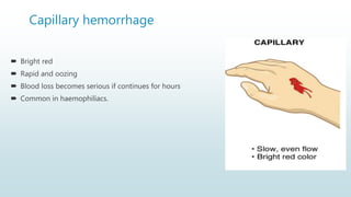 Capillary hemorrhage
 Bright red
 Rapid and oozing
 Blood loss becomes serious if continues for hours
 Common in haemophiliacs.
 