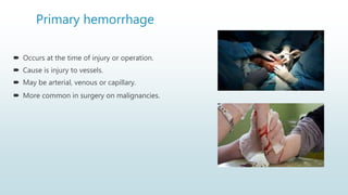 Primary hemorrhage
 Occurs at the time of injury or operation.
 Cause is injury to vessels.
 May be arterial, venous or capillary.
 More common in surgery on malignancies.
 