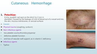 Cutaneous Hemorrhage
1. Petechiae:
A tiny, purplish-red spot on the skin(1 to 2 mm in
diameter). Caused by the leakage of a bit of blood out of a vessel and into
the skin, mucous membranes, or serosal surfaces
 Causes:
 Physical trauma (coughing, sunburn)
 Non-infectious agents
• low platelet counts(thrombocytopenia)
• defective platelet function
• and loss of vascular wall support, as in vitamin C deficiency
 Infectious agents
• Typhus
 