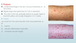 2. Purpura:
 a small hemorrhage in the skin, mucous membrane, or se
sal surface.
 Slightly larger than petechiae (3-5 mm in diameter)
 The color is first red, gradually darkens to purple, fades to
brownish yellow, and usually disappears in 2-3 weeks
 Causes:
can result from the same disorders that cause petechiae, as
as
1) trauma
2) vascular inflammation (vasculitis)
3) increased vascular fragility.
 