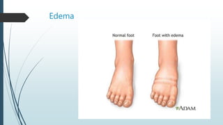 Edema
 