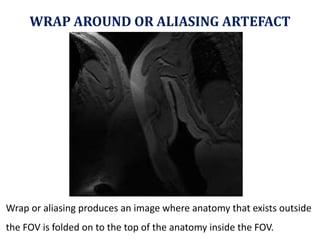 WRAP AROUND OR ALIASING ARTEFACT Wrap or aliasing produces an image where anatomy that exists outside the FOV is folded on to the top of the anatomy inside the FOV. 