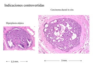 Hiperplasia atípica
Carcinoma ductal in situ
1,5 mm. 3 mm.
Indicaciones controvertidas
 