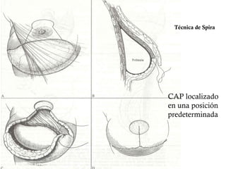 Técnica de Spira
CAP localizado
en una posición
predeterminada
 