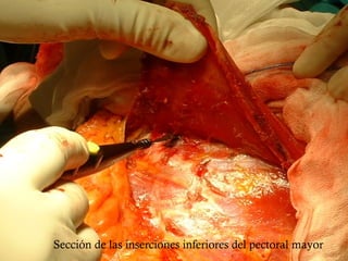 Sección de las inserciones inferiores del pectoral mayor
 