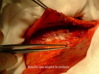 Bolsillo que alojará la prótesis
 