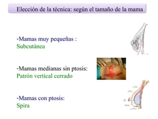 Elección de la técnica: según el tamaño de la mama
-Mamas muy pequeñas :
Subcutánea
-Mamas medianas sin ptosis:
Patrón vertical cerrado
-Mamas con ptosis:
Spira
 
