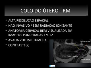 Estadiamento e RM
COLO DO ÚTERO - RMRM
Estadiamento e
• ALTA RESOLUÇÃO ESPACIAL
• NÃO INVASIVO / SEM RADIAÇÃO IONIZANTE
• ANATOMIA CERVICAL BEM VISUALIZADA EM
IMAGENS PONDERADAS EM T2
• AVALIA VOLUME TUMORAL
• CONTRASTE(?)

 