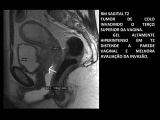 RM SAGITAL T2
TUMOR
DE
COLO
INVADINDO
O
TERÇO
SUPERIOR DA VAGINA.
GEL
ALTAMENTE
HIPERINTENSO
EM
T2
DISTENDE
A
PAREDE
VAGINAL
E
MELHORA
AVALIAÇÃO DA INVASÃO.

 