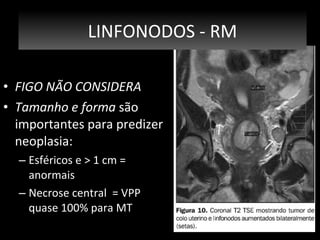 LINFONODOS - RM
• FIGO NÃO CONSIDERA
• Tamanho e forma são
importantes para predizer
neoplasia:
– Esféricos e > 1 cm =
anormais
– Necrose central = VPP
quase 100% para MT

 