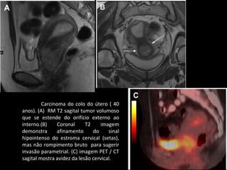 Carcinoma do colo do útero ( 40
anos). (A) RM T2 sagital tumor volumoso
que se estende do orifício externo ao
interno.(B)
Coronal
T2
imagem
demonstra
afinamento
do
sinal
hipointenso do estroma cervical (setas),
mas não rompimento bruto para sugerir
invasão parametrial. (C) imagem PET / CT
sagital mostra avidez da lesão cervical.

 