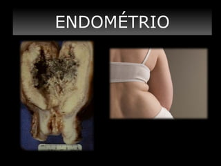 ENDOMÉTRIO
ENDOMÉTRIO

 