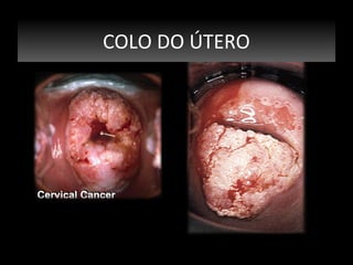 COLO DO ÚTERO
COLO DO ÚTERO

 