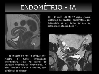 ENDOMÉTRIO - IA
CE - 35 anos. (A) RM T2 sagital mostra
distensão da cavidade endometrial, por
intermédio de um tumor de sinal de
intensidade intermediária (*).

(A)

(B) Imagem de RM T2 oblíqua axial
mostra
o
tumor
intensidade
intermediária (seta) no interior da
cavidade endometrial hiperintensa. A
zona juncional é bem delineada, sem
evidências de invasão.

(B)

 