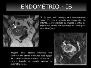 ENDOMÉTRIO - IB
CE - 53 anos. RM T2 oblíqua axial demonstra um
tumor (*) com a invasão do miométrio. No
entanto, a profundidade da invasão é difícil de
determinar devido mal contraste do tumor para
miométrio (seta).

Imagem axial oblíqua dinâmica com
contraste MR obtido 4 minutos após injeção
de contraste mostra aumento do tumor (*)
com a invasão da metade exterior do
miométrio (seta).

 