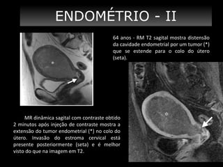ENDOMÉTRIO - II
64 anos - RM T2 sagital mostra distensão
da cavidade endometrial por um tumor (*)
que se estende para o colo do útero
(seta).

MR dinâmica sagital com contraste obtido
2 minutos após injeção de contraste mostra a
extensão do tumor endometrial (*) no colo do
útero. Invasão do estroma cervical está
presente posteriormente (seta) e é melhor
visto do que na imagem em T2.

 