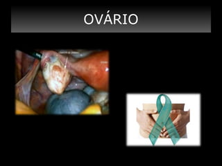 OVÁRIO

 