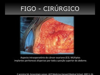 FIGO - CIRÚRGICO

Aspecto intraoperatório do câncer ovariano (E3). Múltiplos
implantes peritoneais dispersos por toda a porção superior do abdome.

C annistra SA. Gynecologic cancer. ACP Medicine.Harvard Medical School, 2007;1-16.

 