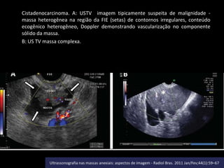 Cistadenocarcinoma. A: USTV imagem tipicamente suspeita de malignidade massa heterogênea na região da FIE (setas) de contornos irregulares, conteúdo
ecogênico heterogêneo, Doppler demonstrando vascularização no componente
sólido da massa.
B: US TV massa complexa.

 