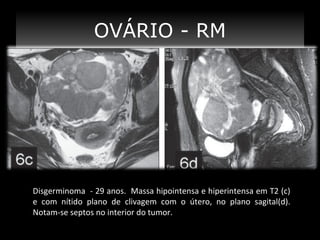 OVÁRIO - RM

Disgerminoma - 29 anos. Massa hipointensa e hiperintensa em T2 (c)
e com nítido plano de clivagem com o útero, no plano sagital(d).
Notam-se septos no interior do tumor.

 