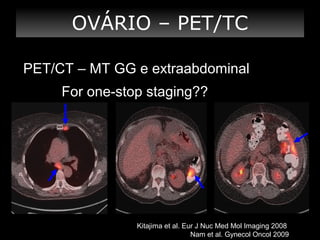OVÁRIO – PET/TC
PET/CT – MT GG e extraabdominal
For one-stop staging??

Kitajima et al. Eur J Nuc Med Mol Imaging 2008
Nam et al. Gynecol Oncol 2009

 