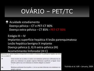 OVÁRIO – PET/TC
 Acuidade estadiamento
Doença pélvica – CT e PET-CT 80%
Doença extra-pélvica – CT 85% - PET-CT 93%
Estágio III – IV
Implantes superfície hepática X lesão parenquimatosa
Lesão hepática benigna X implante
Doença pélvica (I, II) X extra-pélvica (III)
Acometimento linfonodal (III C)

Yoshida et al. AJR – January, 2009

 