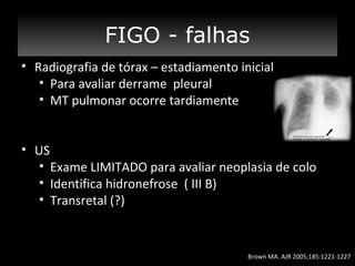 CONCLUSÃO

FIGO - falhas
Estadiamento
• Radiografia de tórax – estadiamento inicial
• Para avaliar derrame pleural
• MT pulmonar ocorre tardiamente
• US
• Exame LIMITADO para avaliar neoplasia de colo
• Identifica hidronefrose ( III B)
• Transretal (?)

Brown MA. AJR 2005;185:1221-1227

 