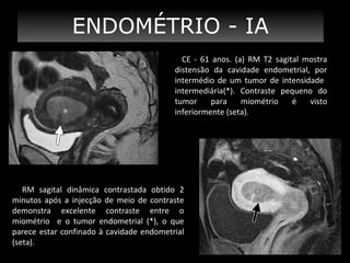 ENDOMÉTRIO - IA
CE - 61 anos. (a) RM T2 sagital mostra
distensão da cavidade endometrial, por
intermédio de um tumor de intensidade
intermediária(*). Contraste pequeno do
tumor
para
miométrio
é
visto
inferiormente (seta).

RM sagital dinâmica contrastada obtido 2
minutos após a injecção de meio de contraste
demonstra excelente contraste entre o
miométrio e o tumor endometrial (*), o que
parece estar confinado à cavidade endometrial
(seta).

 