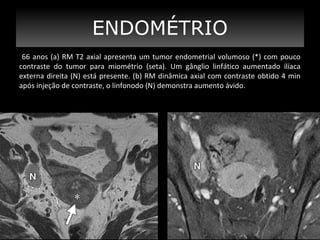 ENDOMÉTRIO
66 anos (a) RM T2 axial apresenta um tumor endometrial volumoso (*) com pouco
contraste do tumor para miométrio (seta). Um gânglio linfático aumentado ilíaca
externa direita (N) está presente. (b) RM dinâmica axial com contraste obtido 4 min
após injeção de contraste, o linfonodo (N) demonstra aumento ávido.

 
