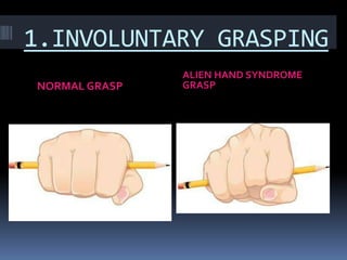 Alien Limb Syndrome Causes