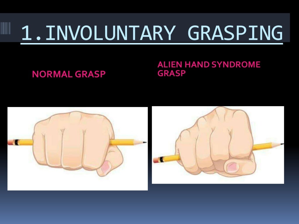 Alien handsyndrome1 r (1)