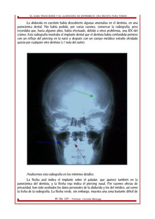 EL ALMA TRASCIENDE Y EL ALIENIGENA SE ESTREMECE: UNA RECETA PARA TODOS 
La abducida en cuestión había descubierto algunas anomalías en el dentista, en una 
panorámica dental. No había podido, por varias razones, conservar la radiografía, pero 
recordaba que, hacia algunos años, había efectuado, debido a otros problemas, una RX del 
cráneo. Esta radiografía mostraba el implante dental que el dentista había confundido primero 
con un reflejo del piercing en la nariz y después con un cuerpo metálico extraño olvidado 
quizás por cualquier otro dentista (¿-? nota del autor). 
Analicemos esta radiografía en los mínimos detalles: 
La flecha azul indica el implante sobre el paladar, que aparece también en la 
panorámica del dentista, y la flecha roja indica el piercing nasal. Por razones obvias de 
privacidad, han sido ocultados los datos personales de la abducida y los del médico, así como 
la fecha de la radiografía. La flecha verde, sin embargo, muestra una zona bastante difícil de 
81 De 135 - Profesor. Corrado Malanga 
 