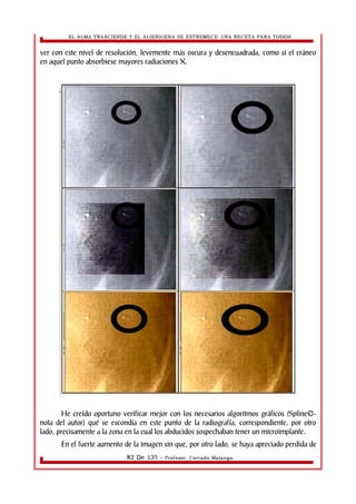 EL ALMA TRASCIENDE Y EL ALIENIGENA SE ESTREMECE: UNA RECETA PARA TODOS 
ver con este nivel de resolución, levemente más oscura y desencuadrada, como si el cráneo 
en aquel punto absorbiese mayores radiaciones X. 
He creído oportuno verificar mejor con los necesarios algoritmos gráficos (Spline©- 
nota del autor) qué se escondía en este punto de la radiografía, correspondiente, por otro 
lado, precisamente a la zona en la cual los abducidos sospechaban tener un microimplante. 
En el fuerte aumento de la imagen sin que, por otro lado, se haya apreciado perdida de 
82 De 135 - Profesor. Corrado Malanga 
 