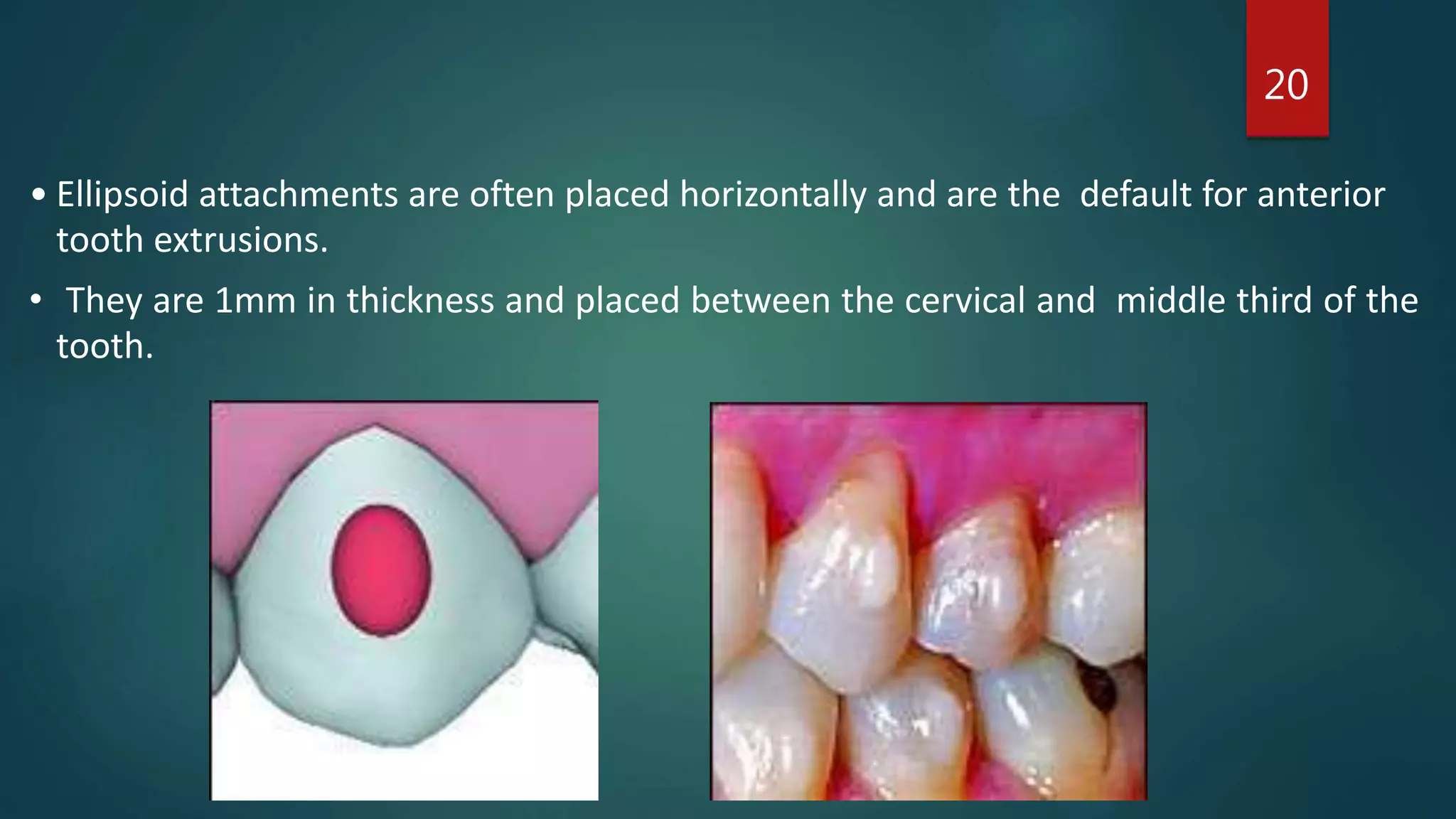 Aligners | PPTX