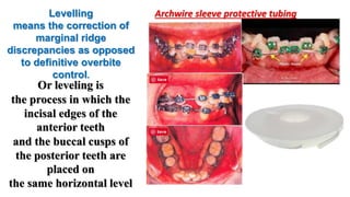 Teeth Leveling Orthodontic alignment phase of pre-adjusted fixed appliance PART 1 | PPTX
