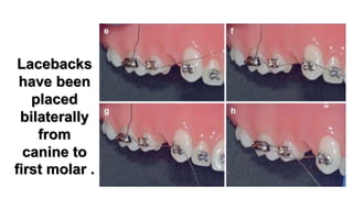 PDF] Effectiveness of laceback ligatures on maxillary canine