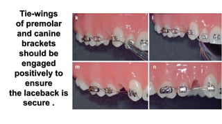 Orthodontic alignment phase of pre-adjusted fixed appliance part 2