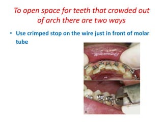 Teeth Leveling Alignment and leveling | PPTX