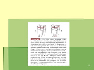 ALIGNMENT AND LEVELING in orthodontic tooth movement | PPT