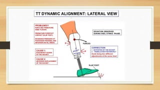Alignment of Trans Tibial Prosthesis | PPTX