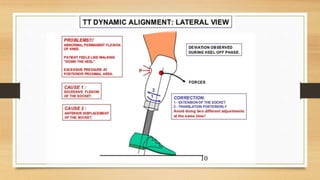 Alignment of Trans Tibial Prosthesis | PPTX