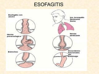 ESOFAGITIS 