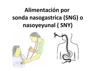 Alimentación por
sonda nasogastrica (SNG) o
nasoyeyunal ( SNY)
 